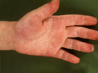 Erythema palmare bij dermatomyositis