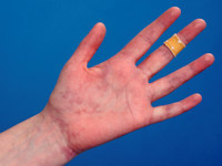 Erythema palmare bij polyarteritis nodosa
