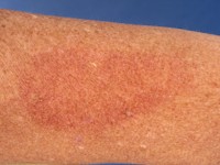 Erythema perstans (fixed drug eruption)