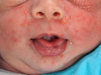 Erythema toxicum neonatorum