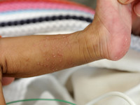 Erythema toxicum neonatorum