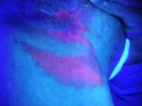 Oranjerood onder de Woods lamp