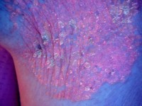 Oranjerood onder de Woods lamp