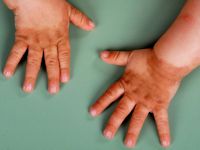 Erythrokeratoderma variabilis