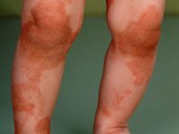 Erythrokeratoderma variabilis