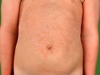 Erythrokeratoderma variabilis