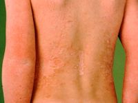 Erythrokeratoderma variabilis