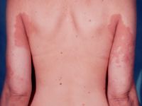 Erythrokeratoderma variabilis