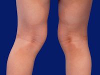 Erythrokeratoderma variabilis