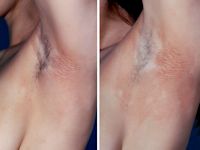 Erythrokeratoderma variabilis