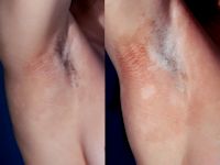 Erythrokeratoderma variabilis