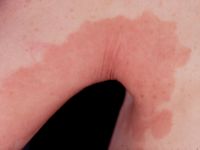 Erythrokeratoderma variabilis