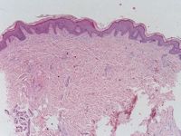 Erythrokeratoderma variabilis