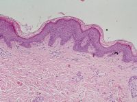 Erythrokeratoderma variabilis