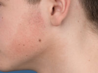 Erythromelanosis follicularis faciei et colli