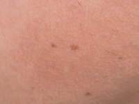 Erythromelanosis follicularis faciei et colli