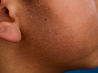 Erythromelanosis follicularis faciei et colli