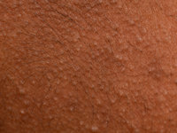 Erythromelanosis follicularis faciei et colli