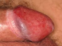 Erythroplasie van Queyrat