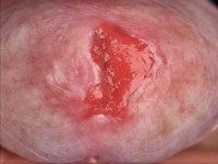 Erythroplasia of Queyrat