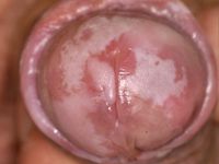 Erythroplasia of Queyrat