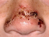 Erythropoietische protoporfyrie