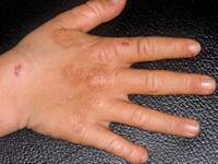 Erythropoietische protoporfyrie