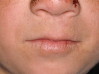 Erythropoietische protoporfyrie