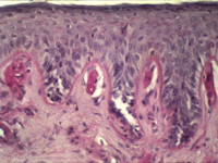 Erythropoietische protoporfyrie