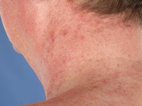 Erythrosis interfollicularis colli