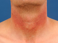 Erythrosis interfollicularis colli