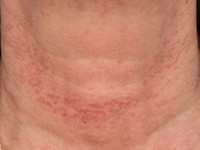 Erythrosis interfollicularis colli