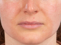 Erythrosis pigmentosa peribuccalis