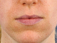 Erythrosis pigmentosa peribuccalis