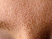 Erythrosis pigmentosa peribuccalis