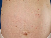 Essentiële teleangiëctasieën