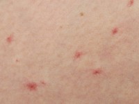 Essentiële teleangiëctasieën