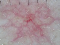 Essentiële teleangiëctasieën