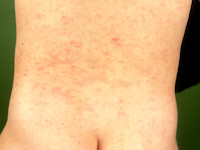 Exanthema subitum, roseola infantum, sixth disease
