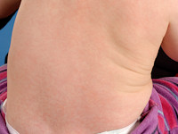 Exanthema subitum, roseola infantum, sixth disease