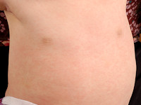 Exanthema subitum, roseola infantum, sixth disease