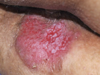 Paget, extramammaire vorm