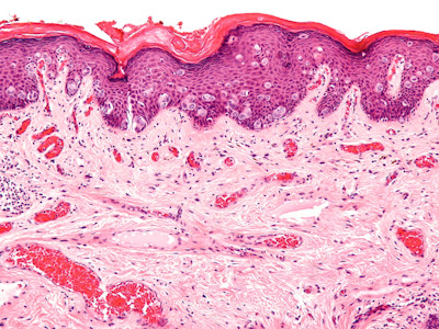 Paget, extramammaire vorm