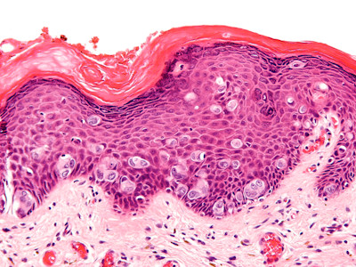 Paget, extramammaire vorm