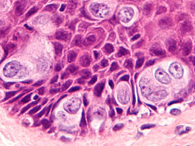 Paget, extramammaire vorm