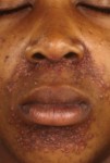 Facial Afro-Caribbean Eruption of Childhood