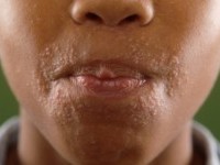 Facial Afro-Caribbean Eruption of Childhood