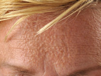 Idiopathic facial papules