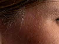 Idiopathic facial papules