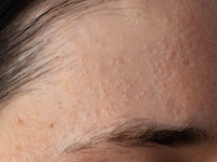 Idiopathic facial papules